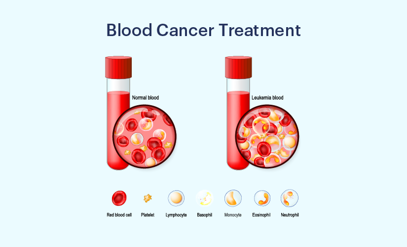 Blood Cancer Treatment